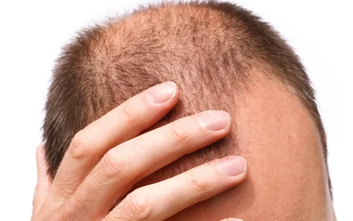 alopecia androgenética, queda de cabelo;