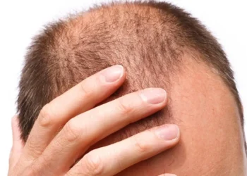 alopecia androgenética, queda de cabelo;