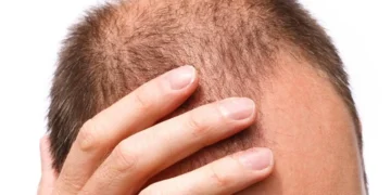 alopecia androgenética, queda de cabelo;